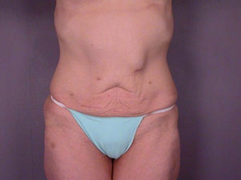 Tummy Tuck before 280113