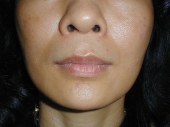 Radiesse in smile lines (Nasolabial Folds) before 100937