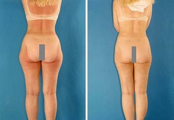 Liposuction before 636249