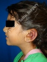 Ear Surgery (Otoplasty) 579092