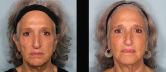 Sculptra before 460615