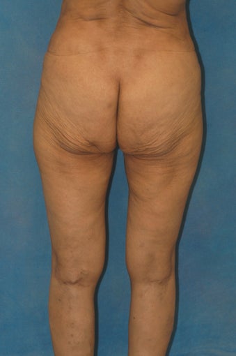 Women's Buttocks Augmentation 518128