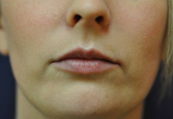 Lip Augmentation with Filler before 560211