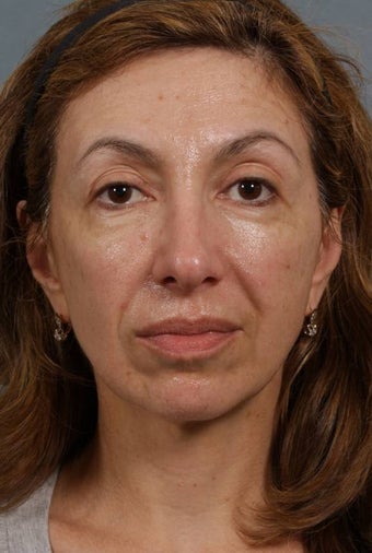 Sculptra before 269571