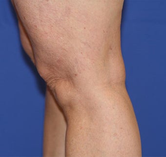 VASER Shape to Legs before 433063