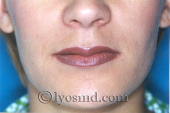 Lip Augmentation after 225377