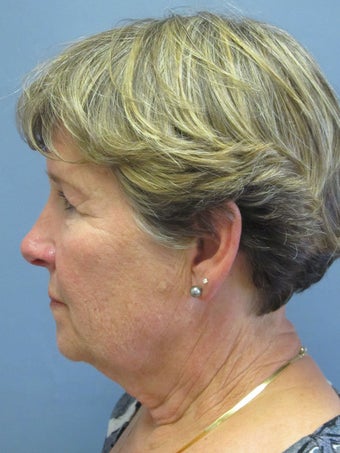 Neck Lift, Platysmaplasty 634749