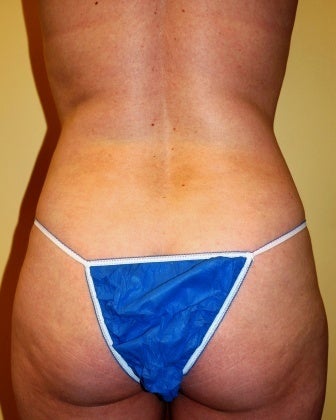 Body Jet (water assisted) liposuction before 235768
