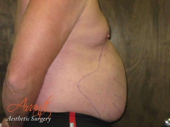 Vaser Lipo - Abdomen before 376426