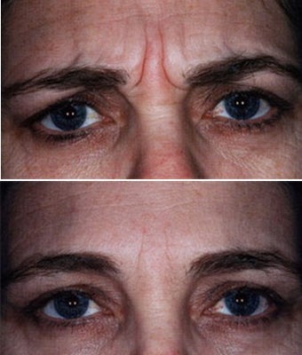 Showing Expression Before and After Botox before 6331