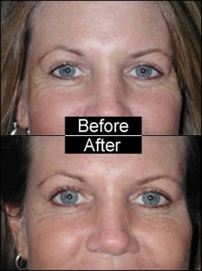 Botox for Crows Feet and Laugh Lines before 97311