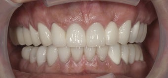 full mouth restoration 363948
