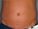 Liposonix before 582725
