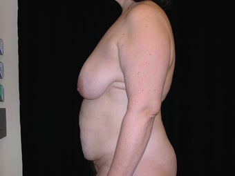 Mommy Makeover before 233746