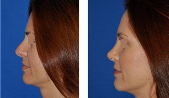 Revision Rhinoplasty before 293544