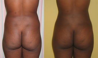 Buttock Augmentation before 459509