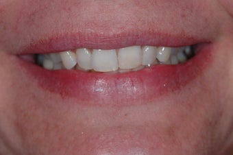 Combination Invisalign and Lumineers before 356802