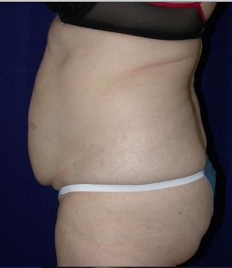 Tummy Tuck (abdominoplasty) 208467