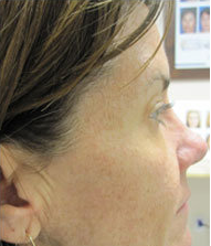 Botox 387834