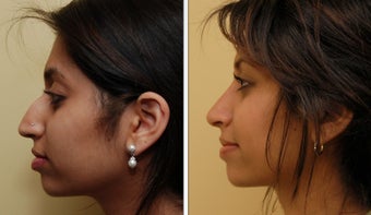 Ethnic Rhinoplasty before 271733