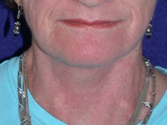 Necklift after 208438