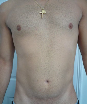 Smartlipo / liposuction after 166269