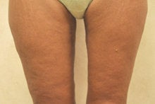 Medial (Inner) Thigh Lift after 341015