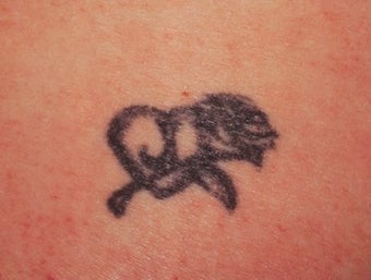 Laser tattoo removal before 374510