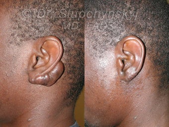 Keloid Removal before 565822