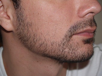 Facial Hair Transplant 321260