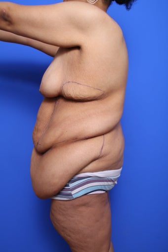 Body Lift with Panniculectomy before 623706