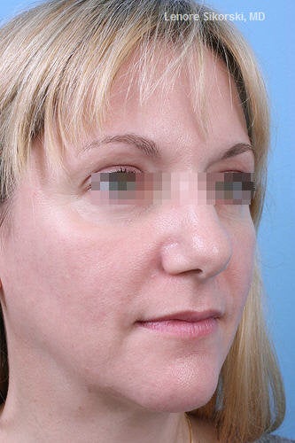 Fractional CO2 Laser Resurfacing after 114175