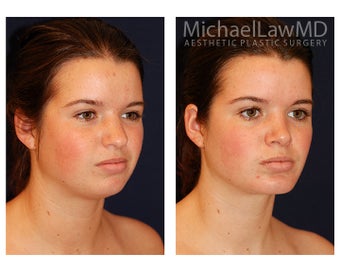 Chin Liposuction after 395814