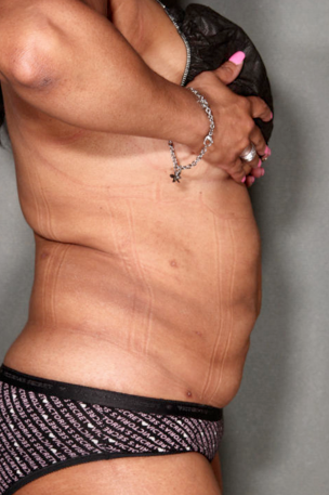 SmartLipo™ 529445