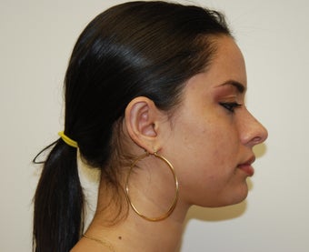 Otoplasty 320201