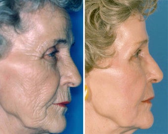 Chemical Peel before 652148