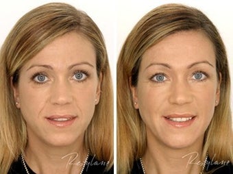 Before and after restylane full face before 6275