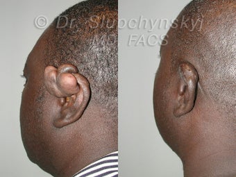 Keloid Removal before 563856