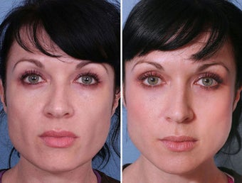 Sculptra Filler in Cheek Hollows before 242559