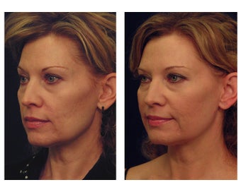 YAG Laser Skin Tightening before 490518