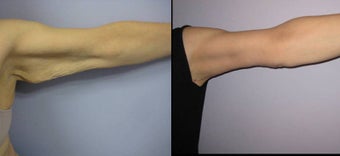 Brachioplasty - Arm Lift before 391026