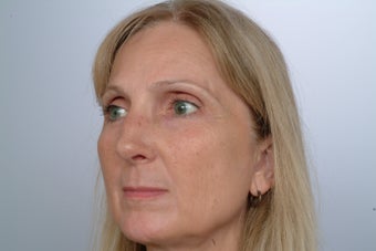 Revision Rhinoplasty 358580