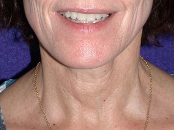 Necklift after 208444