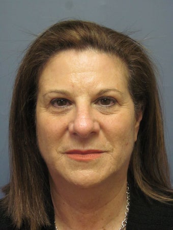 Neck Lift, Platysmalasty before 634751