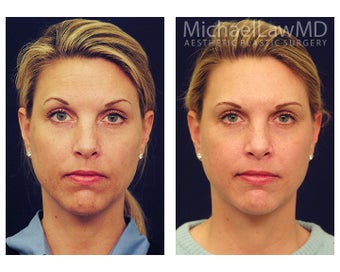 Chin Liposuction before 395819