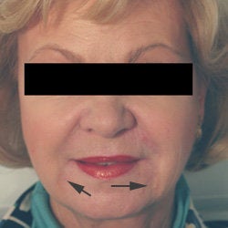 Oral Commissures (marionette lines) with Restylane Treatment after 93346