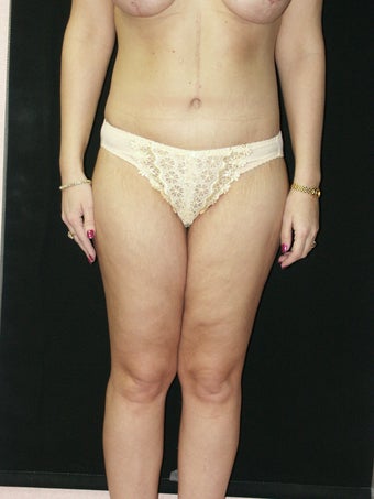 Body Lift and Inner Thigh Lift after 379793