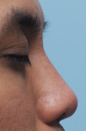 Non Surgical Rhinoplasty after 307848