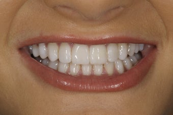 Resin bonding smile makeover on a teenager. after 326342