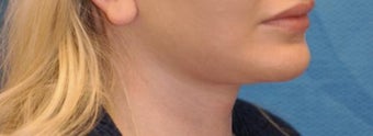 Lip Augmentation after 399264